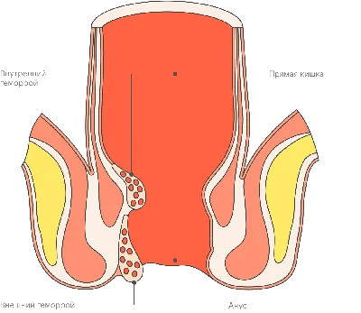 Анальная трещина – фото, симптомы, лечение, операция, иссечение - клиника  \"СОЮЗ\"