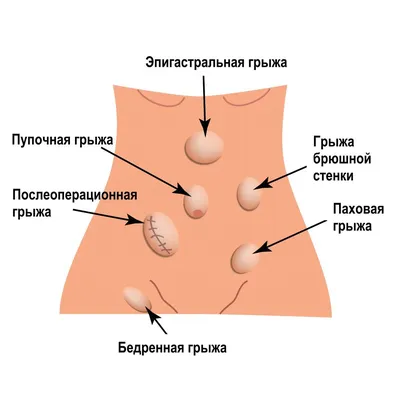 Геморрой: симптомы, причины, наружный и внутренний, стоимость лечения и  операции