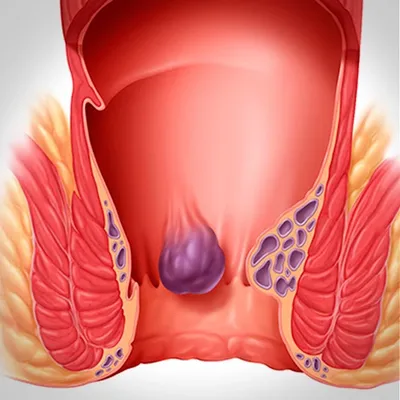 Геморрой простыми словами - Хирург Проктолог Онколог