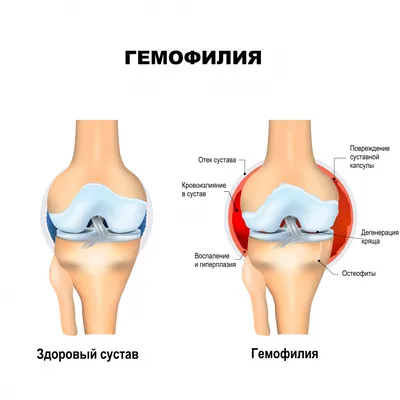 Операции на геморрой безболезненно в СПБ - виды, цены