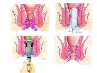 Геморрой: фото, симптомы, в т.ч. при беременности; лечение