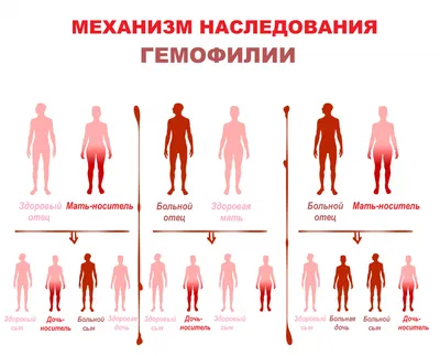 Лазерное удаление внутреннего и наружного геморроя в Киеве ≡ MED CITY |  Лечение геморроя лазером