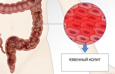 Мазь Релиф от геморроя с фенилэфрином: описание, способы применения