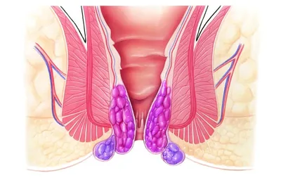 Лечение внешнего(наружного) геморроя в СПб - цены, отзывы, фото
