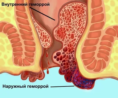 Наружный геморрой - лечение внешних геморроидальных узлов