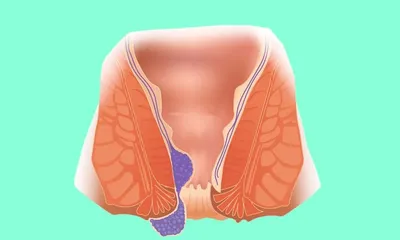 4 первых признака и 5 симптомов геморроя