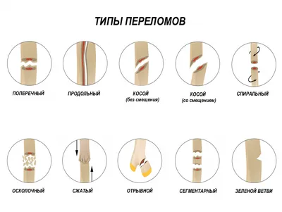 Перелом кости - причины появления, симптомы заболевания, диагностика и  способы лечения