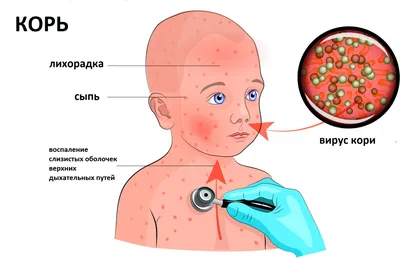 Вирус Коксаки у детей и взрослых: симптомы, лечение, как передается,  инкубационный период