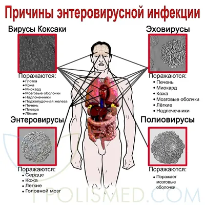 Вирус Коксаки. Что о нем нужно знать. Опыт собственный. |  TurmamaForYou/Отдых с детьми | Дзен