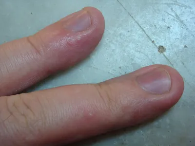 Фото водянистых пузырьков на пальцах рук в стиле гранж