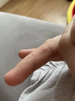 Водянистые пузырьки на пальцах рук в формате 4K