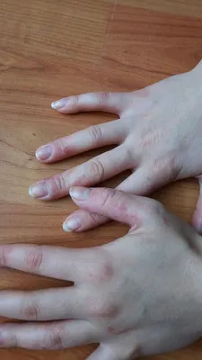 Картинка водянистых высыпаний на коже рук в HD качестве