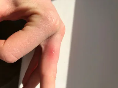 Фотография водянки на пальце руки: в черно-белом стиле