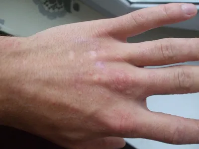 Фото водяных пузырьков на пальцах рук в разных размерах и форматах
