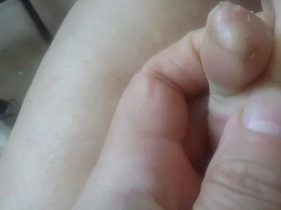 Водяные пузырьки на пальцах рук в высоком качестве