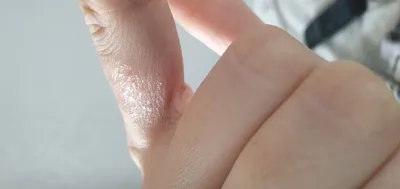 Водяные пузырьки на пальцах рук: прекрасное изображение