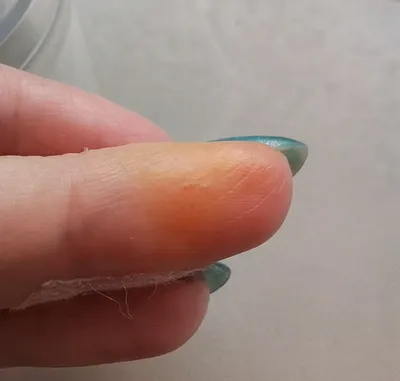 Водяные пузырьки на пальцах рук: красивые фотки