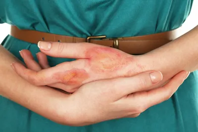 Фотки волдырей на пальцах рук: как правильно ухаживать за кожей