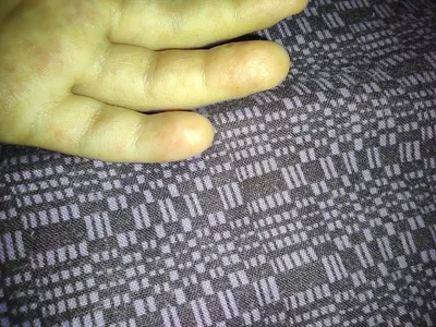 Изображения волдырей на пальцах рук для диагностики кожных заболеваний