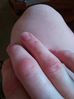 Какие бывают волдыри на пальцах рук