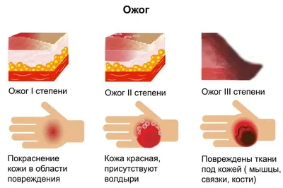 Фотография волдырей на руках: JPG формат для скачивания