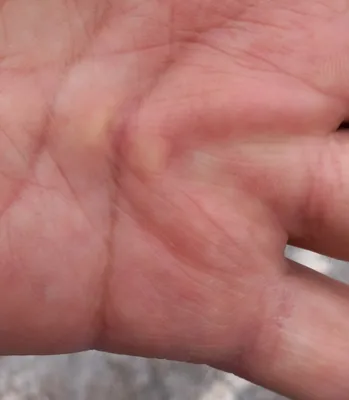 Рука с воспаленным сухожилием: скачать в высоком качестве