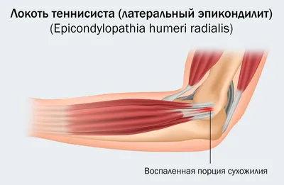 Воспаление сухожилия на руке фотографии