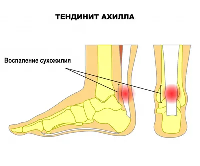 Воспаленное сухожилие на руке в формате PNG