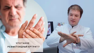 Фото воспаленных суставов пальцев рук для лекарственных препаратов