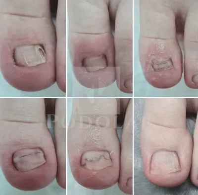 Фотографии вросших ногтей на руках: увеличьте для детального просмотра