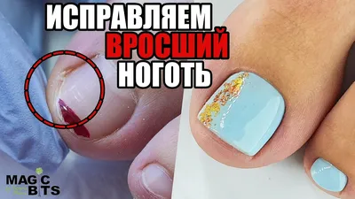 Фотографии вросших ногтей на руках: как избежать травмирования ногтевой пластины