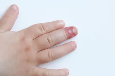Фото вросшего ногтя на руке: причины и лечение