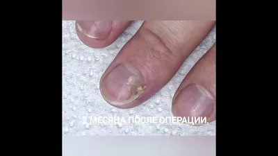 Изображение вросшего ногтя на руке и бородавкой на пальце