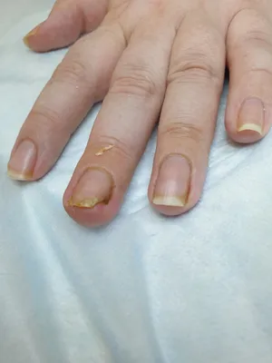 Изображение вросшего ногтя на руке и шелушением кожи