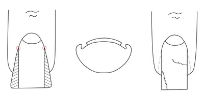 Фото вросшего ногтя на руке: как правильно подрезать