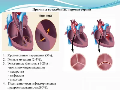 Врожденные пороки сердца картинки фото