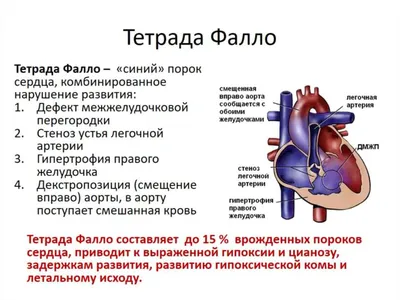 Почему возникают врожденные пороки сердца: какими они бывают – краткий гайд  для родителей | О детском здоровье: с врачебного на родительский | Дзен