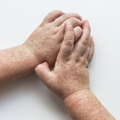 Крупное изображение высыпаний на коже рук в формате JPG