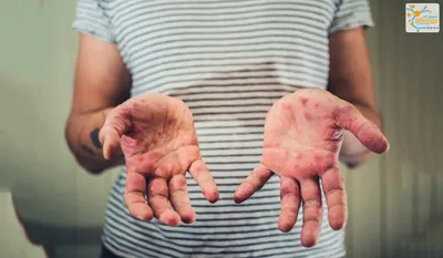 Фотография высыпаний на коже рук для диагноза