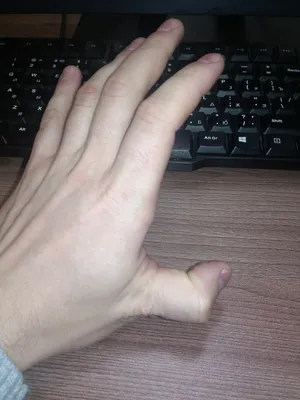 Вывих большого пальца руки: фото с близкого расстояния