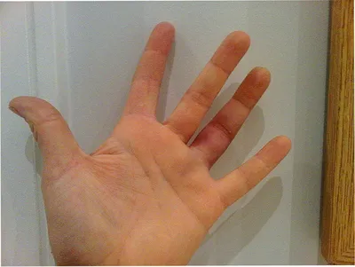 Вывих пальца руки: фотография в высоком разрешении