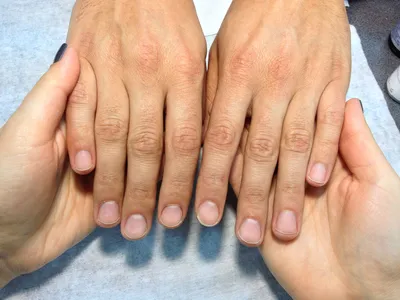 Фотография вывиха пальца руки у людей с повышенной подвижностью суставов