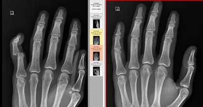 Фотография вывиха пальца руки у людей с остеохондрозом
