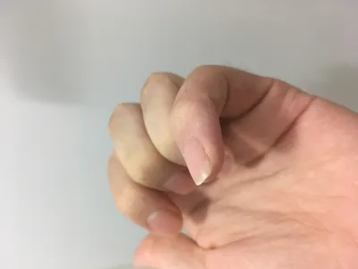 Фото руки с повреждением