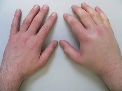 Фотография вывиха пальца руки у спортсменов