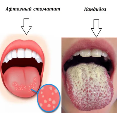 Глоссит | Стоматология Бескудниково