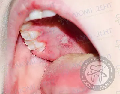 Красные пятна на языке: симптомы и лечение глоссита — ROOTT