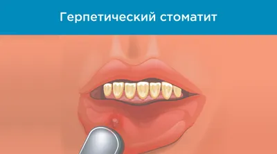 Противопоказания к имплантации зубов - Cтоматология Май