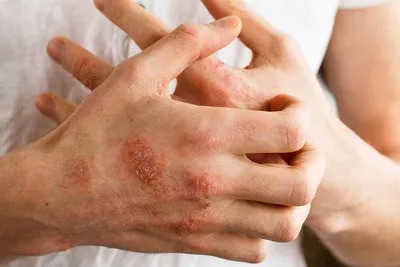 Фото заболевания кожи рук в формате JPG