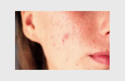 Фотографии заболеваний кожи рук: как избавиться от экземы и дерматита